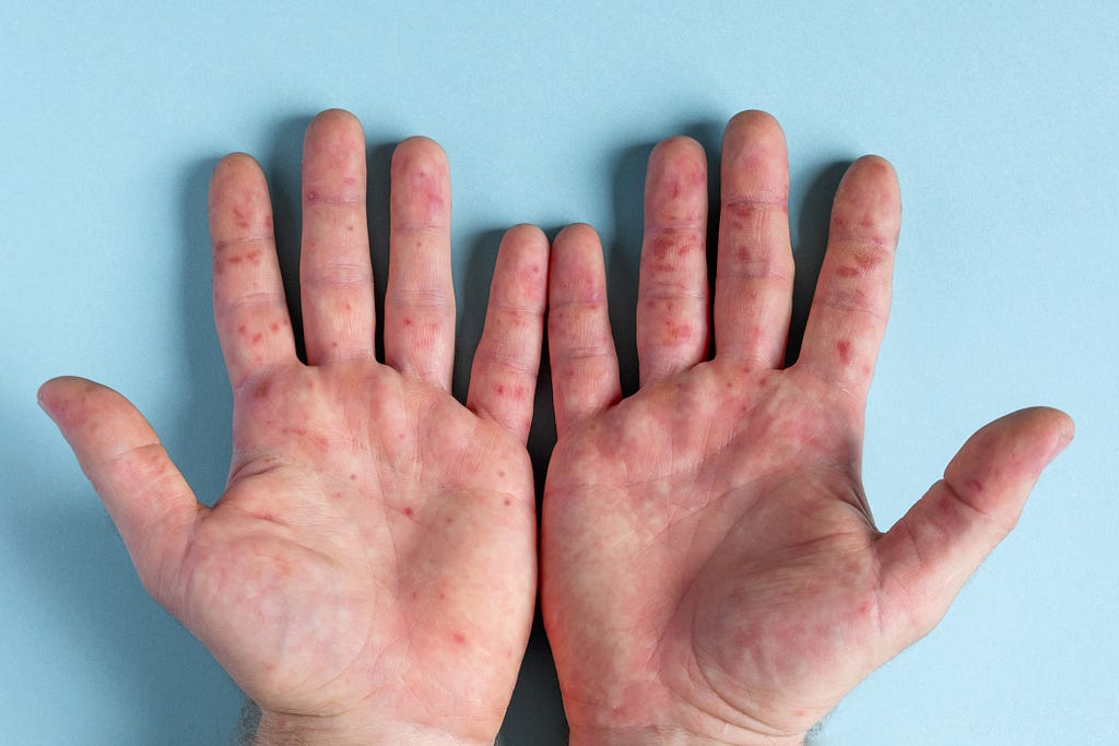 A person when affected with this diseases it produce red and painful blisters on skin.