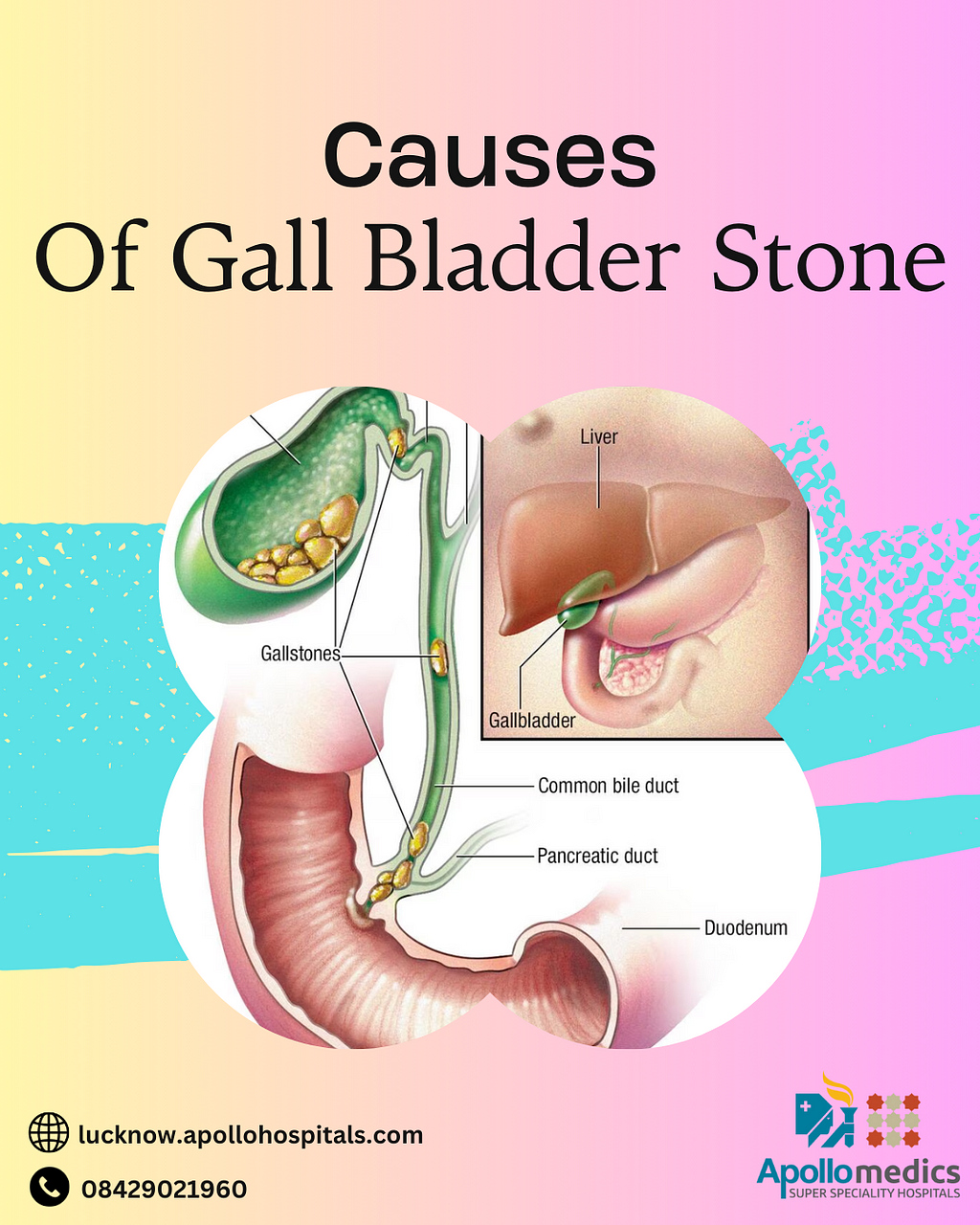 Gall Bladder Stone Causes