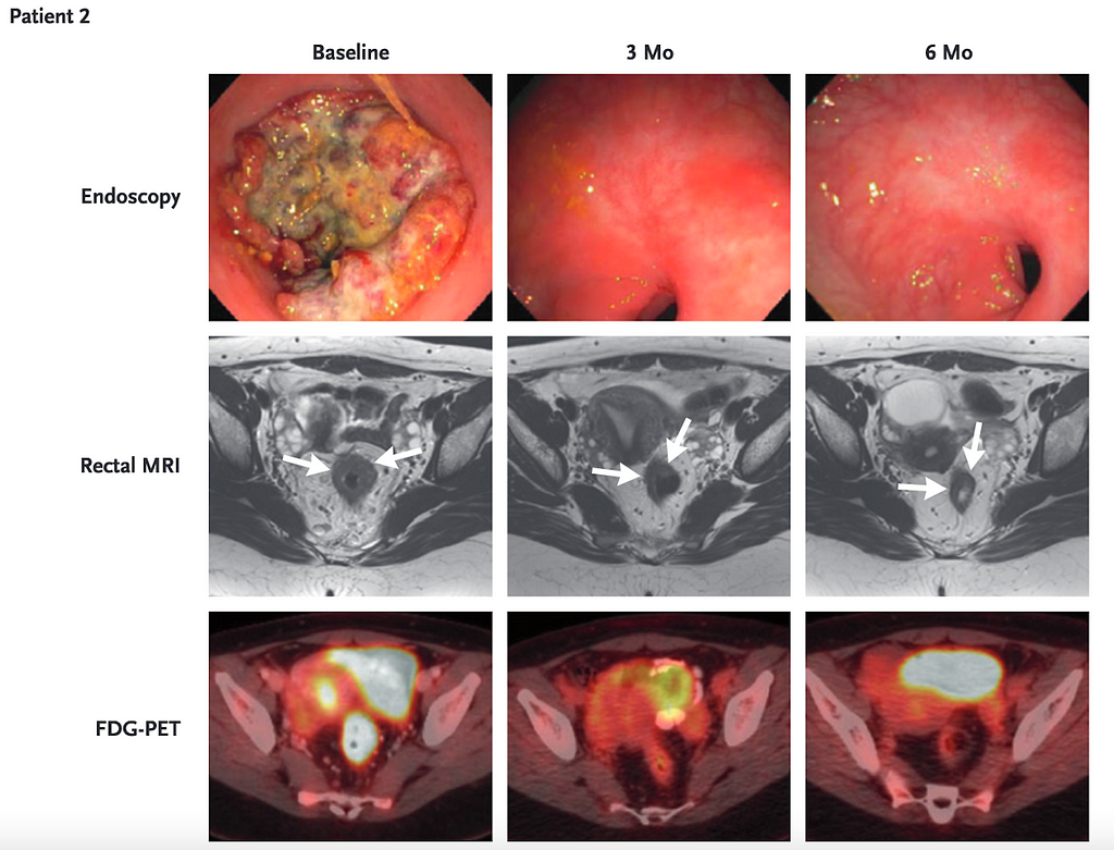 Complete regression of a rectal tumor in a patient after receiving 6-months of anti-PD-1 antibody treatment.