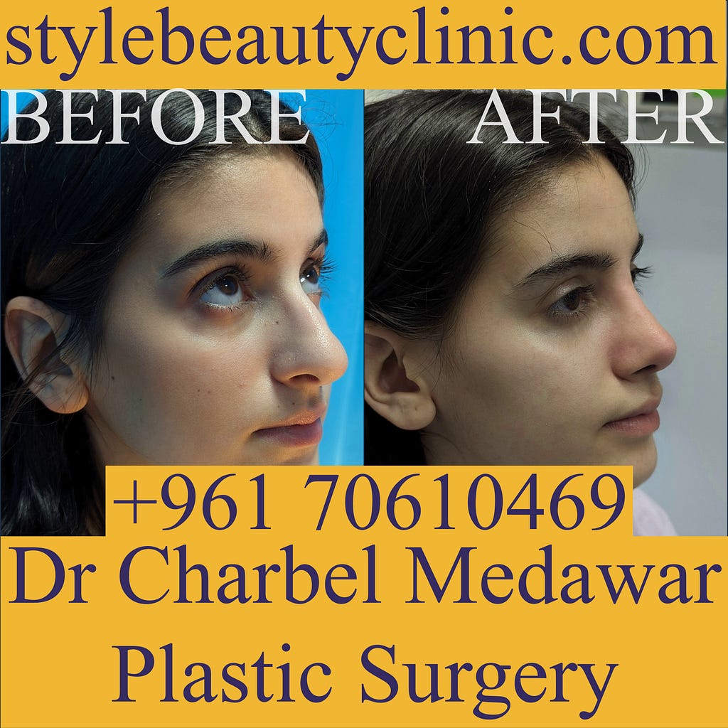 top rhinoplasty surgeon lebanon