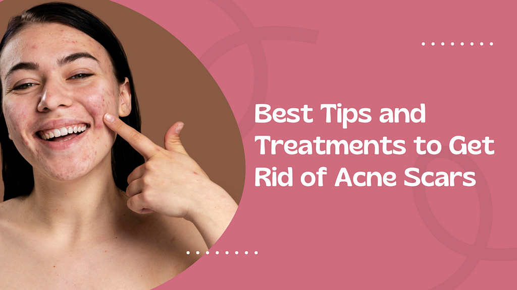 Best Tips and Treatments to Get Rid of Acne Scars