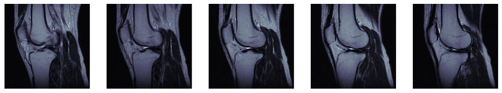 Five sequential knee CT scan stills in the sagittal plane.