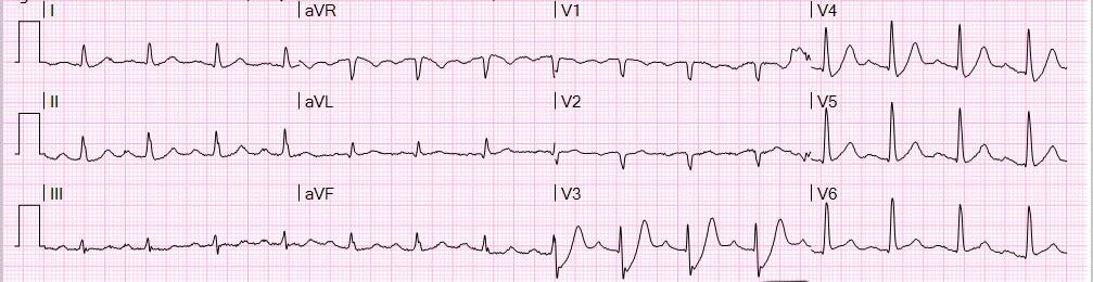 除了STE以外,還有哪些ECG sign也有可能血管阻塞呢?(前言)