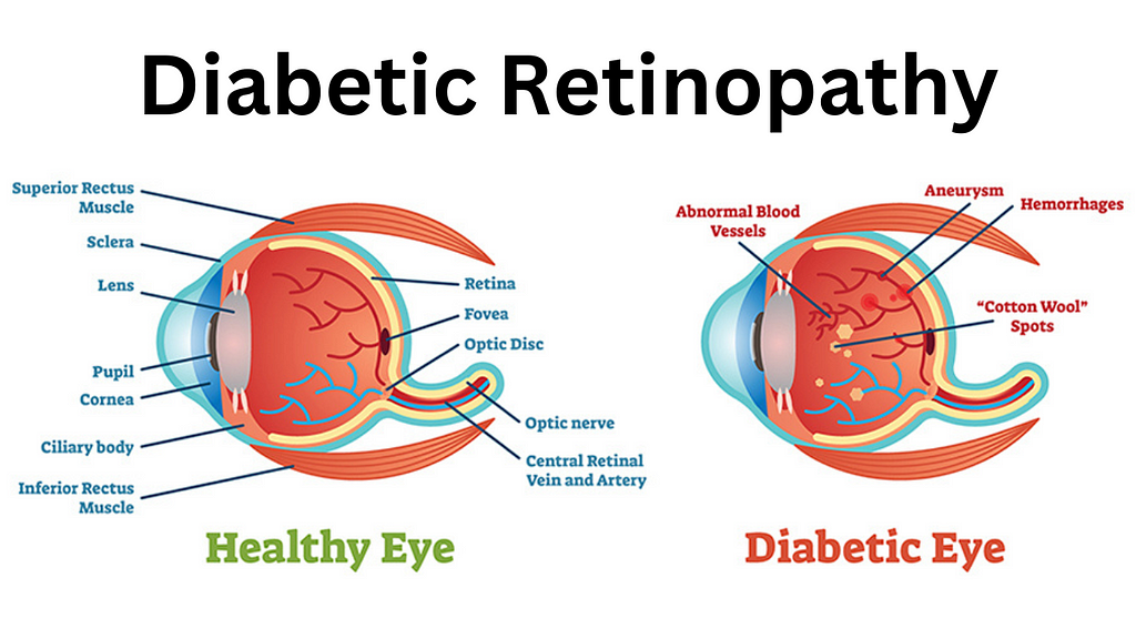 Diabetic Retinopathy: