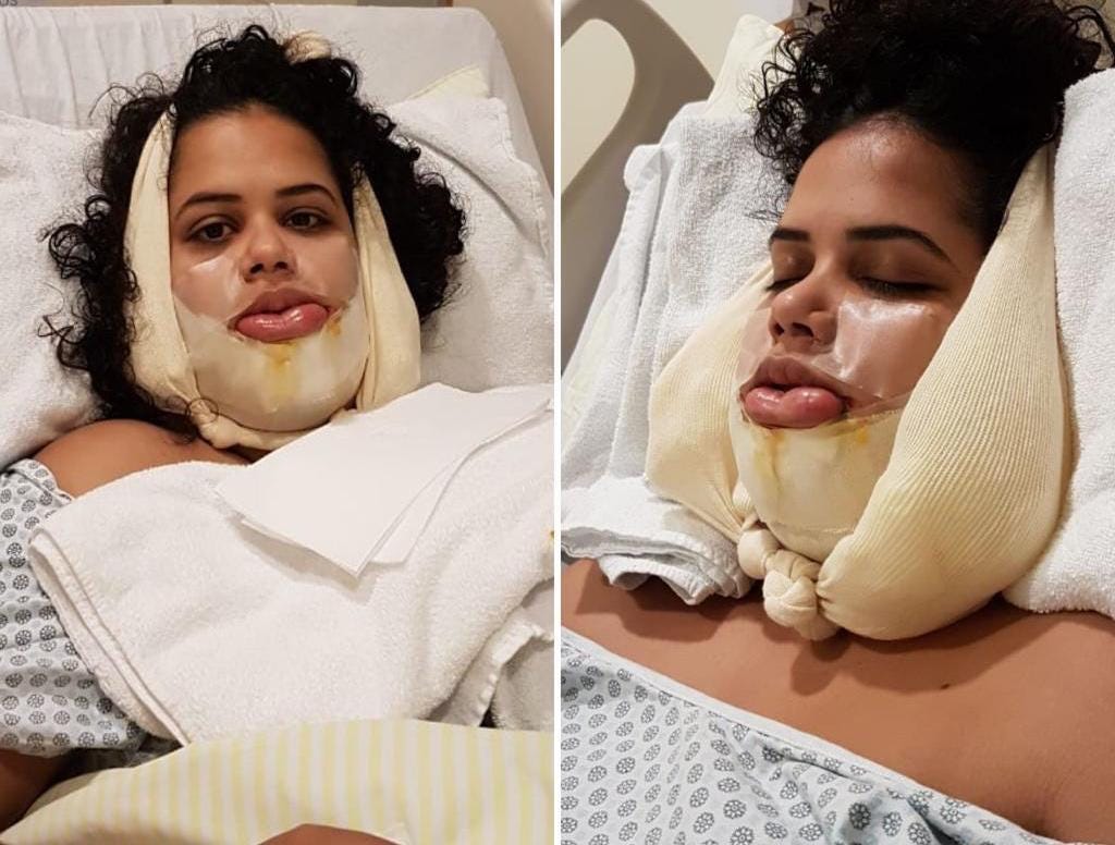 mulher deitada em cama de hospital após uma cirurgia ortognática