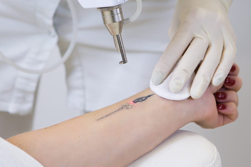 Best Tattoo Removal Clinic in Indirapuram