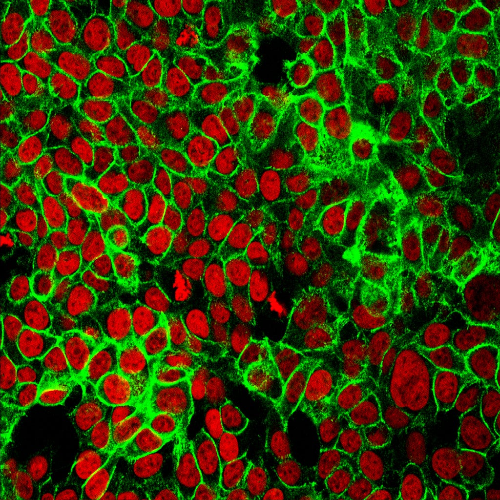 Human Colon Cancer Cells. In red, the nuclei; in green, a protein (Photo by NCI Center for Cancer Research, CC0 Public Domain