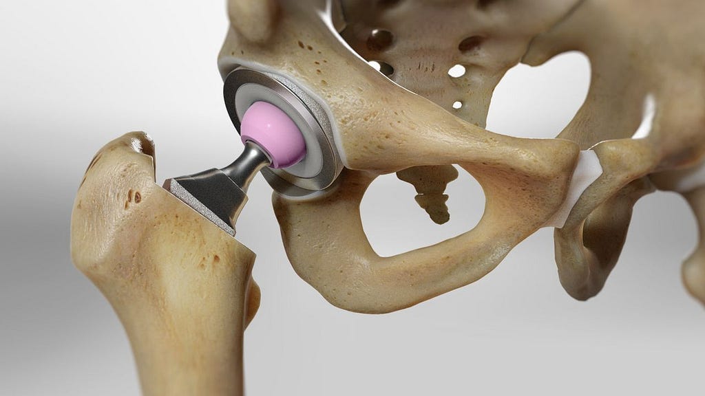 Hip Replacement in Boultham