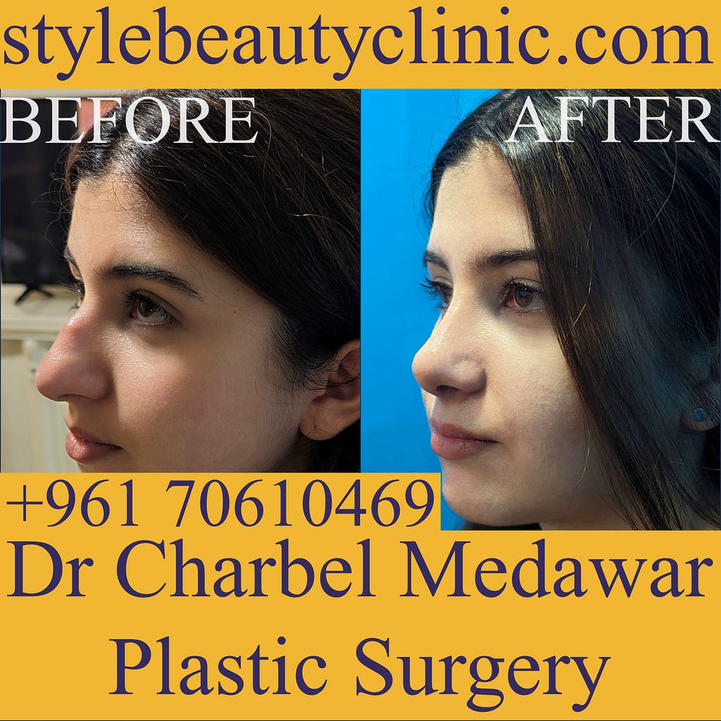 rhinoplasty price lebanon