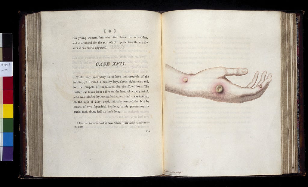 Printed work with an illustration of cowpox infection on hand.