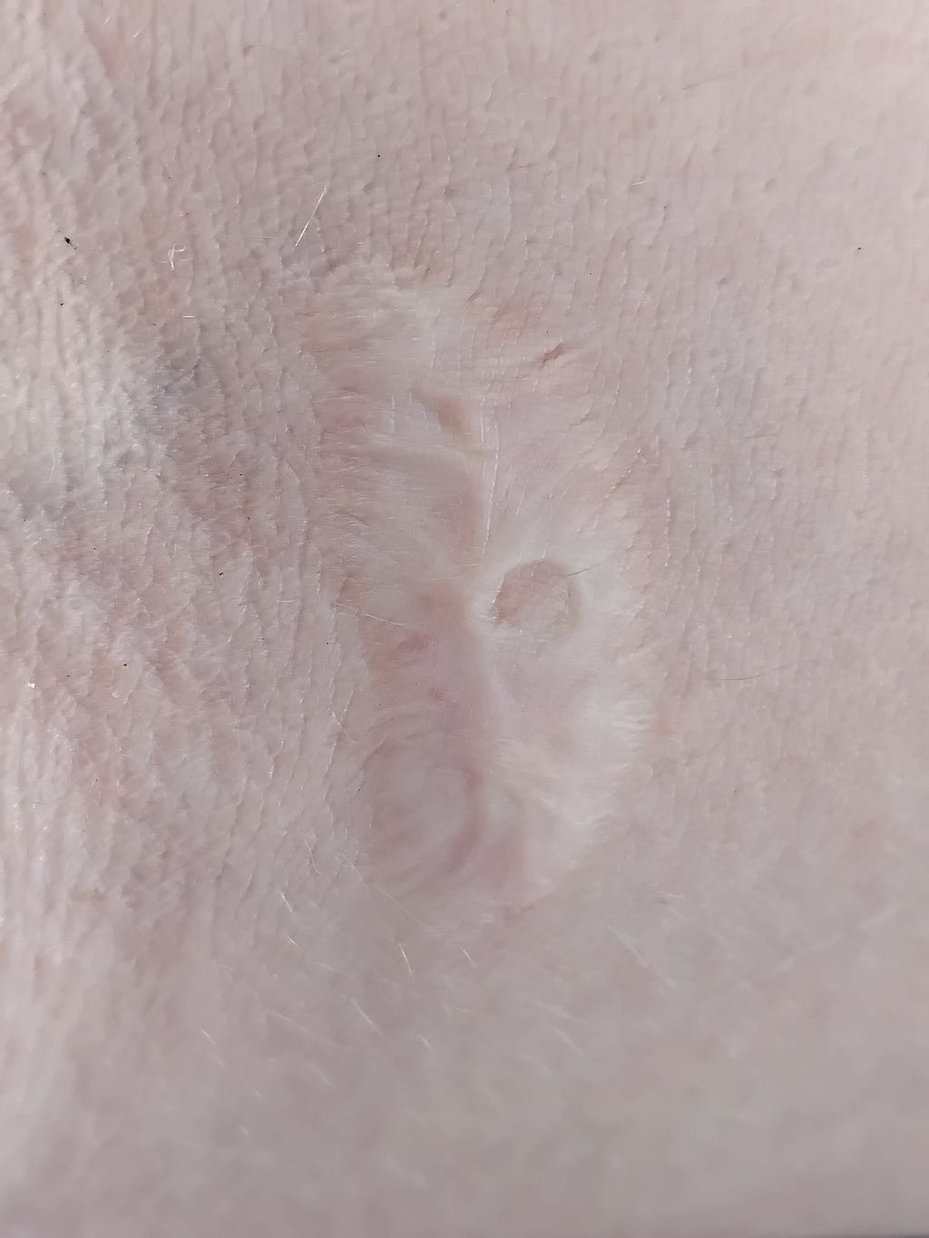 A close-up of a lighter burn scar in crook of elbow on a caucasian arm