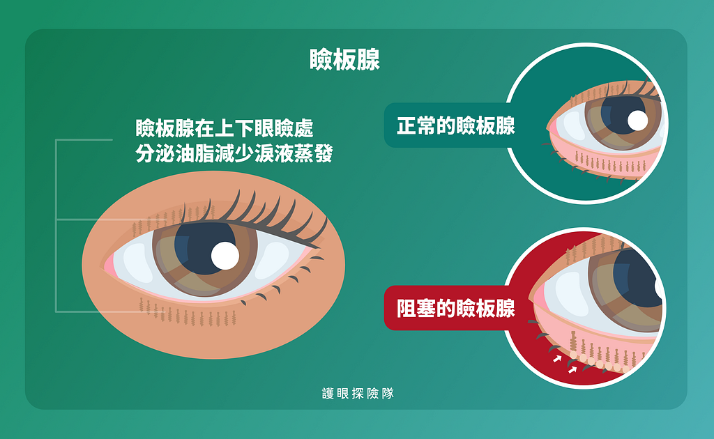 乾眼症可能是瞼板腺阻塞引起的