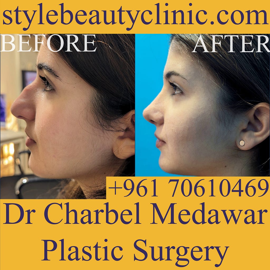 nose plastic surgery lebanon dr charbel medawar