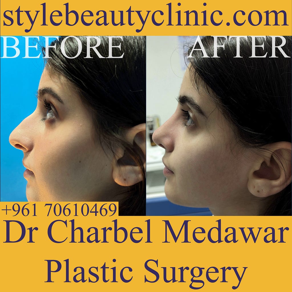 top nose job surgeon lebanon dr charbel medawar