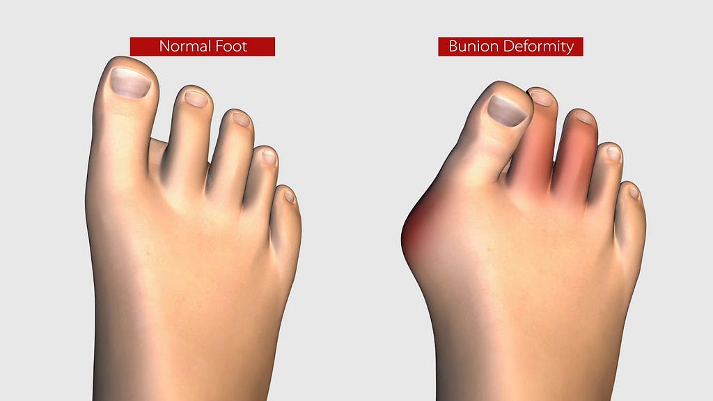 Types And Causes Of bunion Surgery