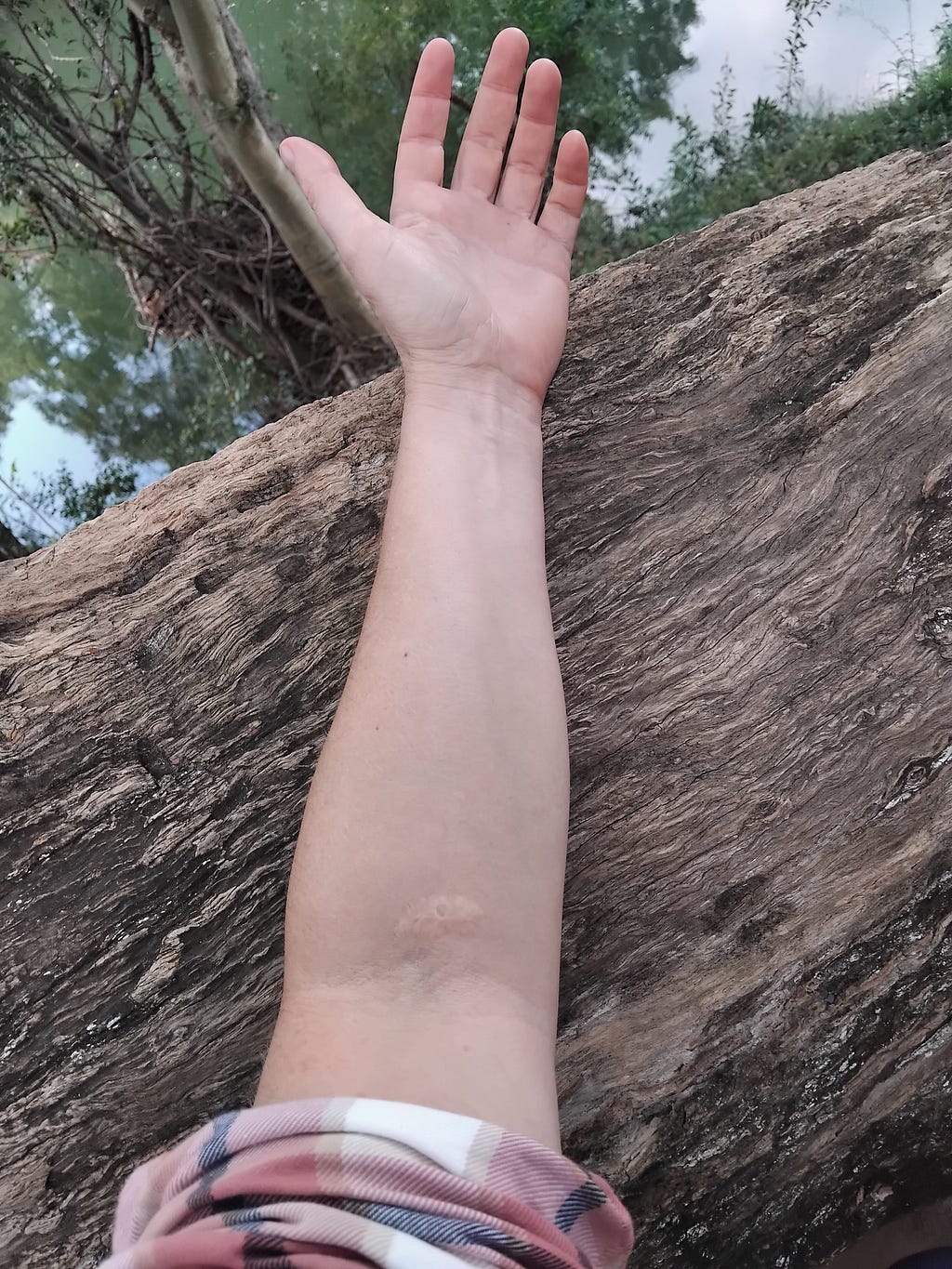 An arm with a lighter burn scar in the crook of the elbow with a large tree stump and a river in the background