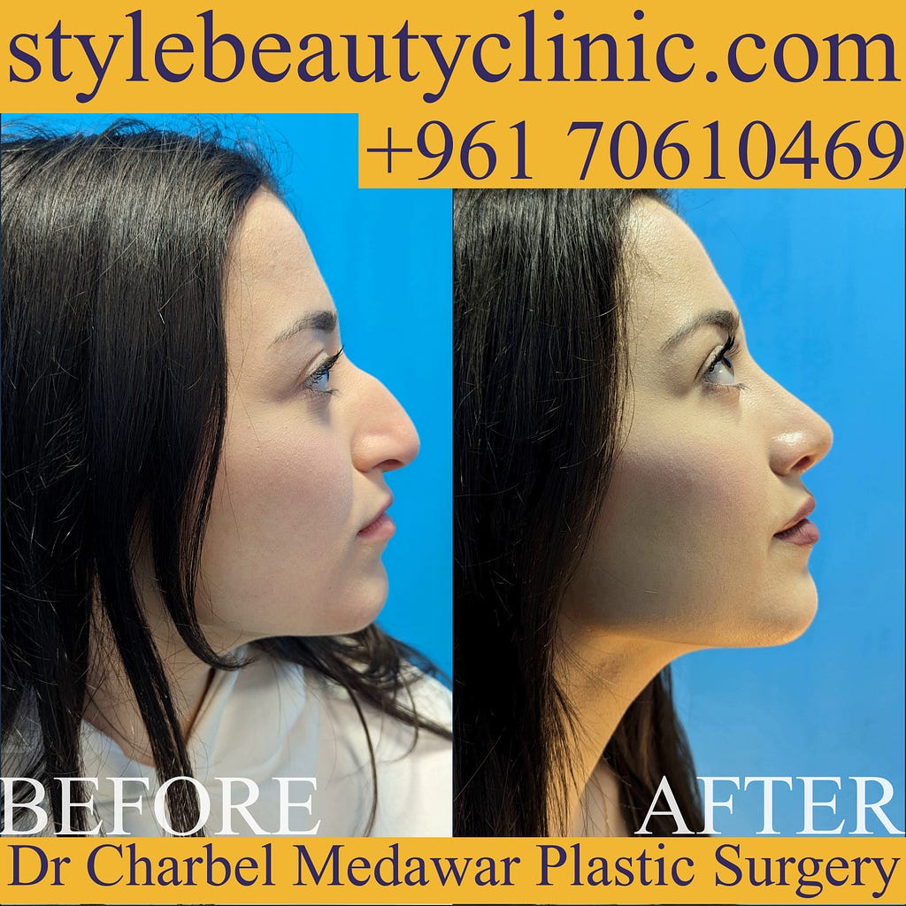 best nose surgeon in lebanon dr charbel medawar