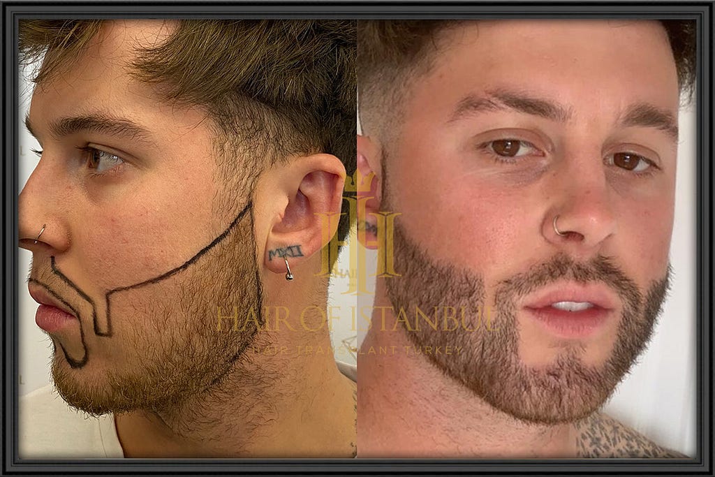 Beard Transplant, Hair of Istanbul