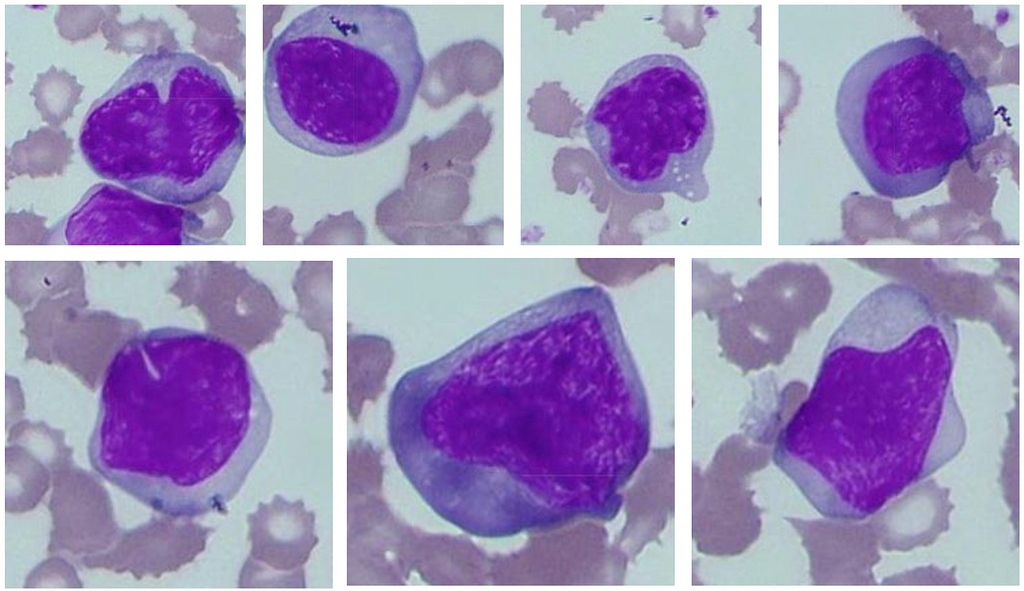 Infectious Mononucleosis — The Enigma of Mononucleosis Syndrome