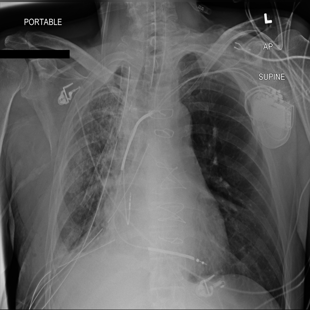 Chest X-Ray Abnormality Classification Using Monk AI