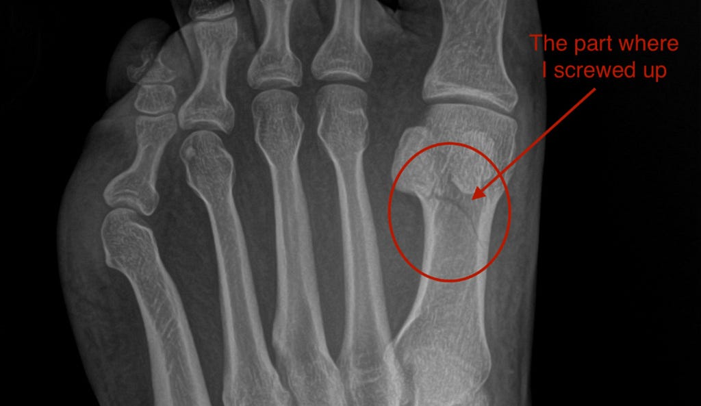 X-ray of the left foot showing a curved break through the first metatarsal, circled on the picture with the words “The part where I screwed up”.