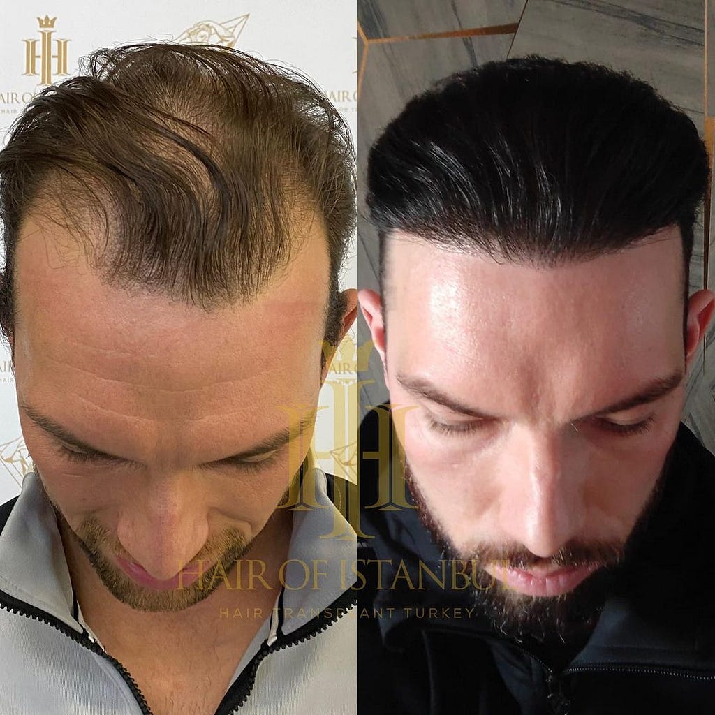 Hair Transplant Before and After, Hair of Istanbul