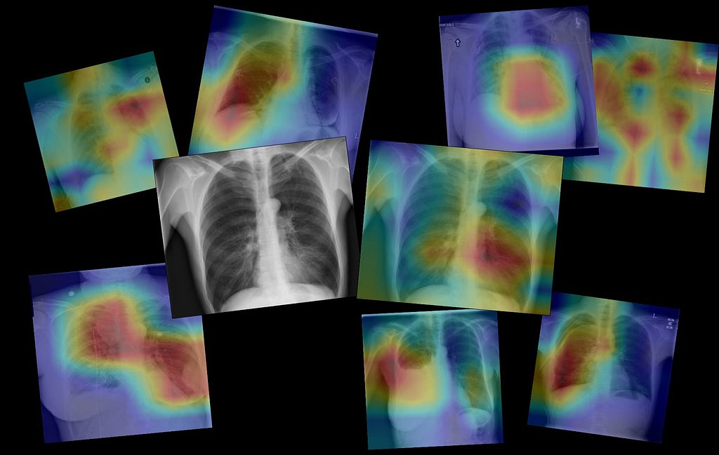 Different X-rays images with degrading color focus on a possible lesions in the thoraxic part