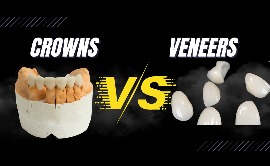 Veneers vs crowns