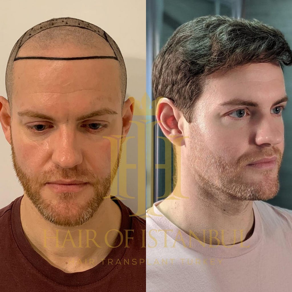 Physical Effects of Hair Transplantation Hair of Istanbul