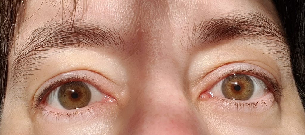 Close-up of the part of a person’s face from just below the eyes to just above the eyebrows. The person’s eyes are open. The eye colour is hazel. There are shadows from a mesh window blind across the face.