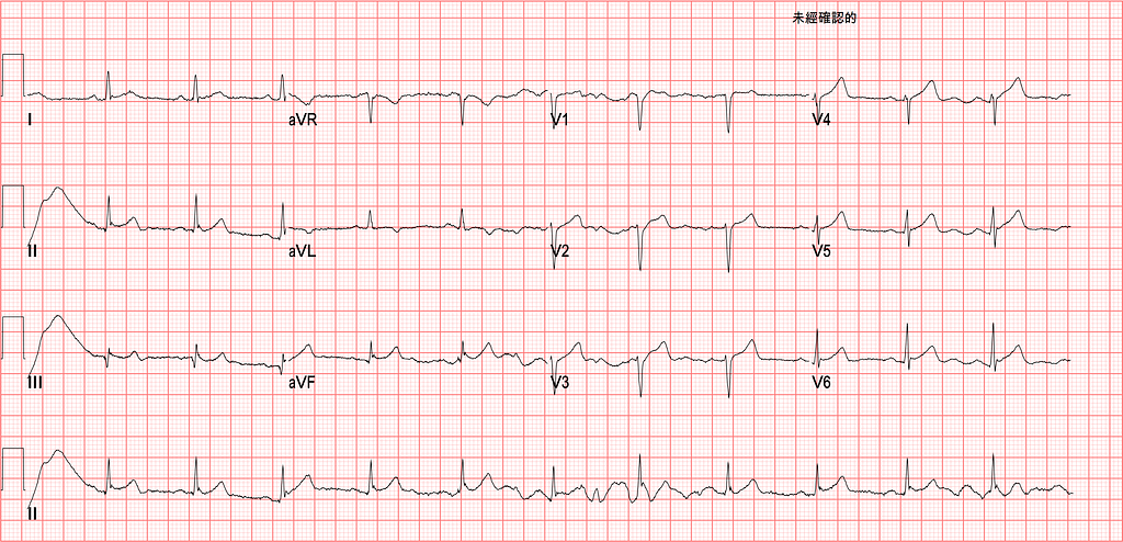 心臟警訊:Pericarditis vs. OMI— 再次入院