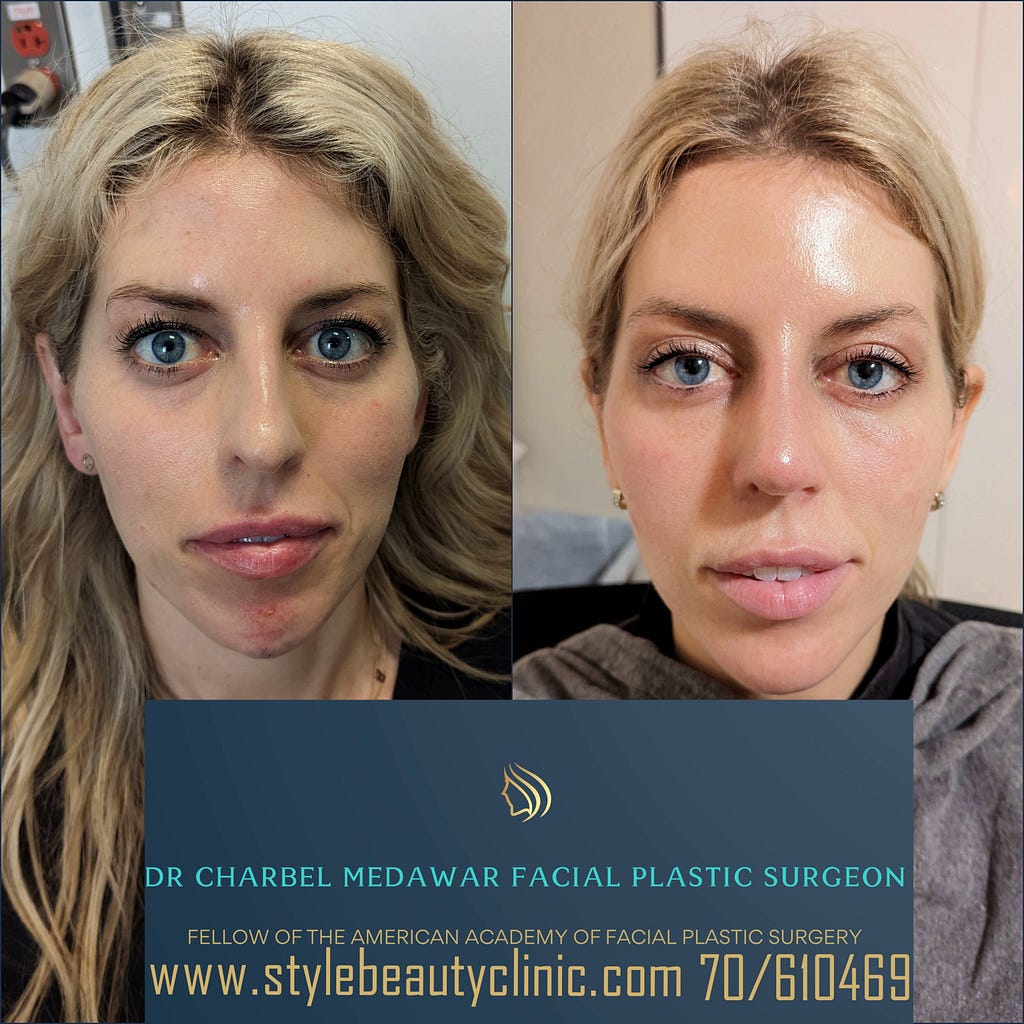 heidi bitton shreveport before after makeover plastic surgery dr charbel medawar