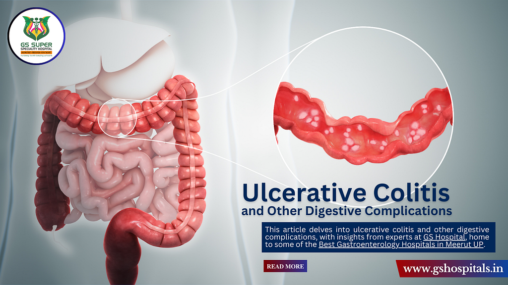 Ulcerative Colitis and Other Digestive Complications