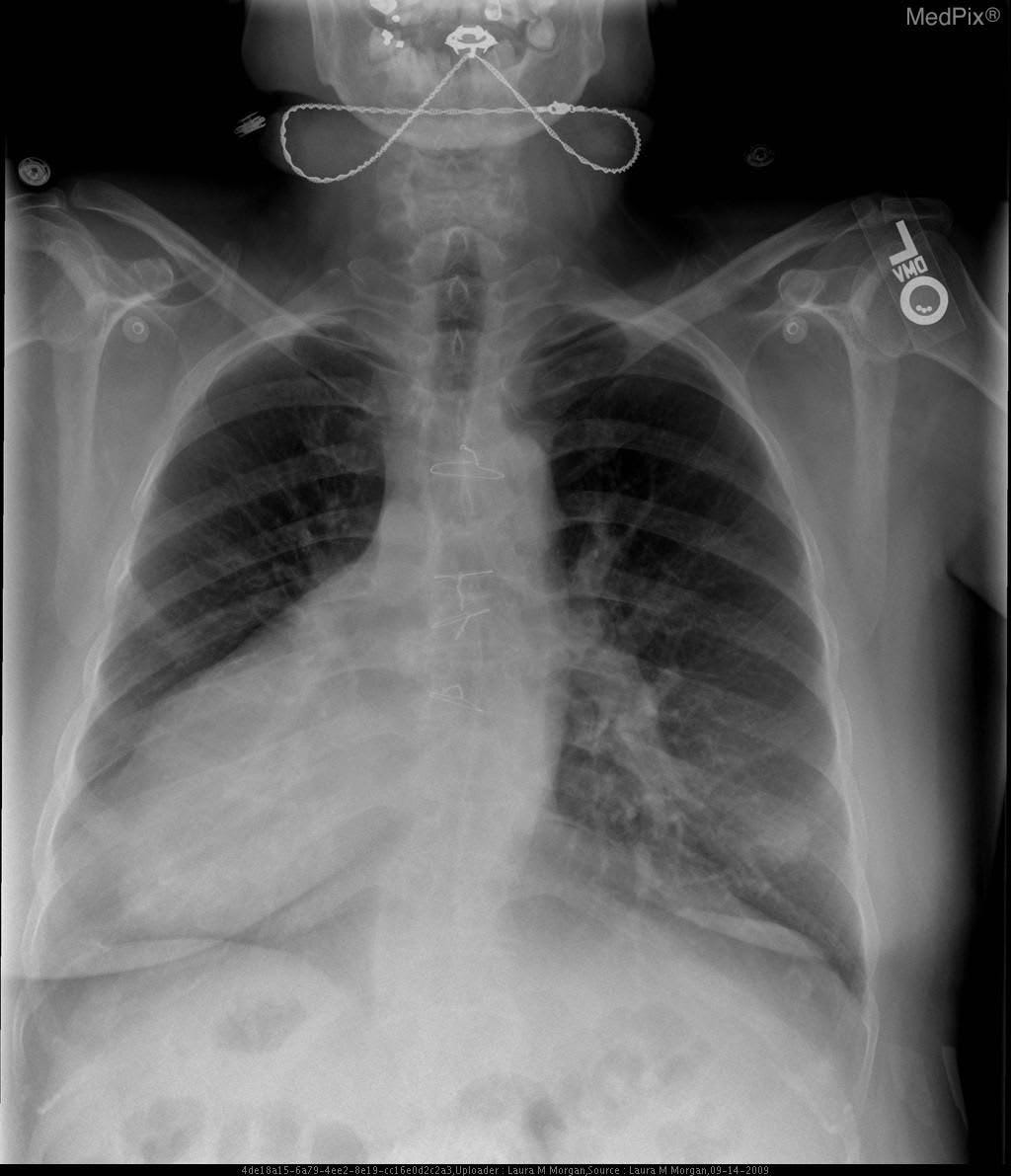 Posterior-Anterior X-ray with situs inversus with dextrocardia