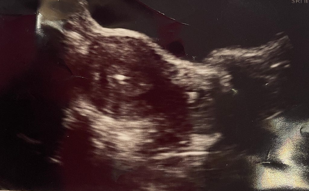 An ultrasound image of a womb, mostly dark with a white air bubble in the centre
