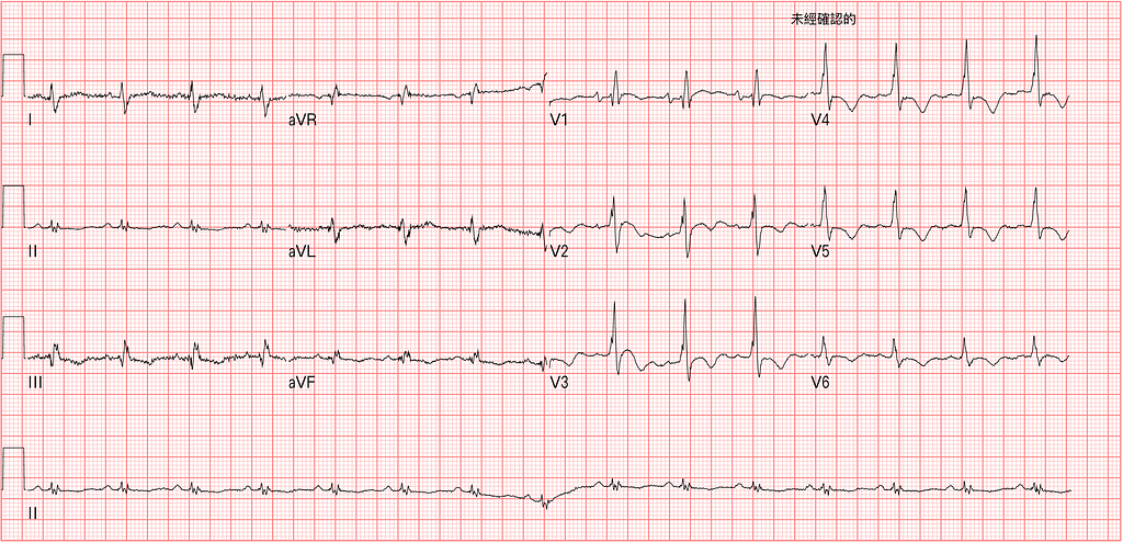 胸痛，是Wellen嗎?