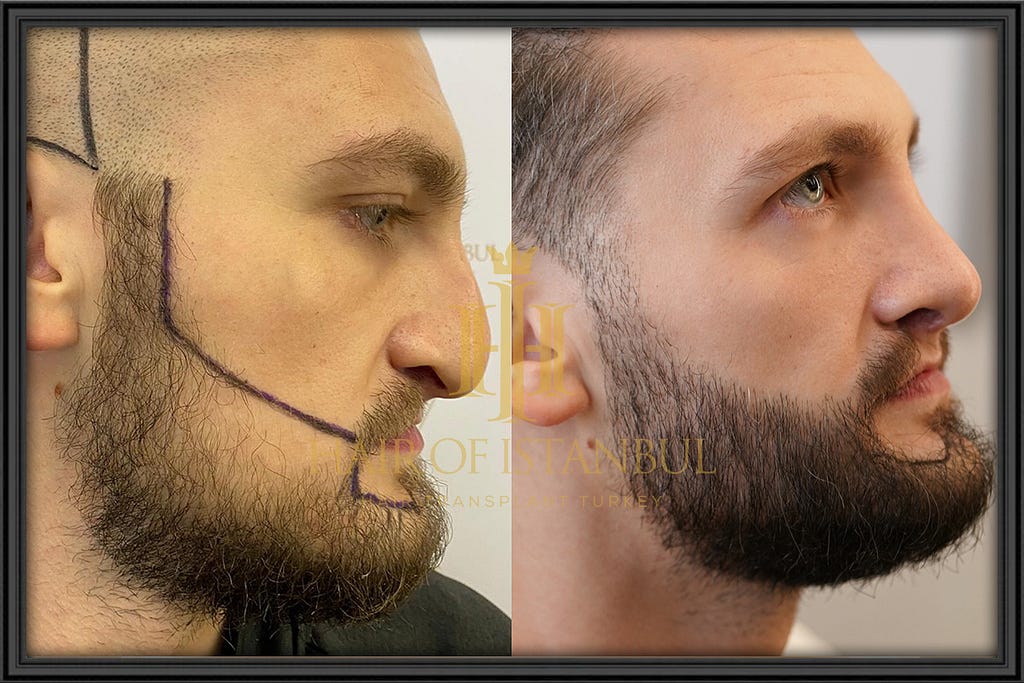 Beard Transplant, Hair of Istanbul