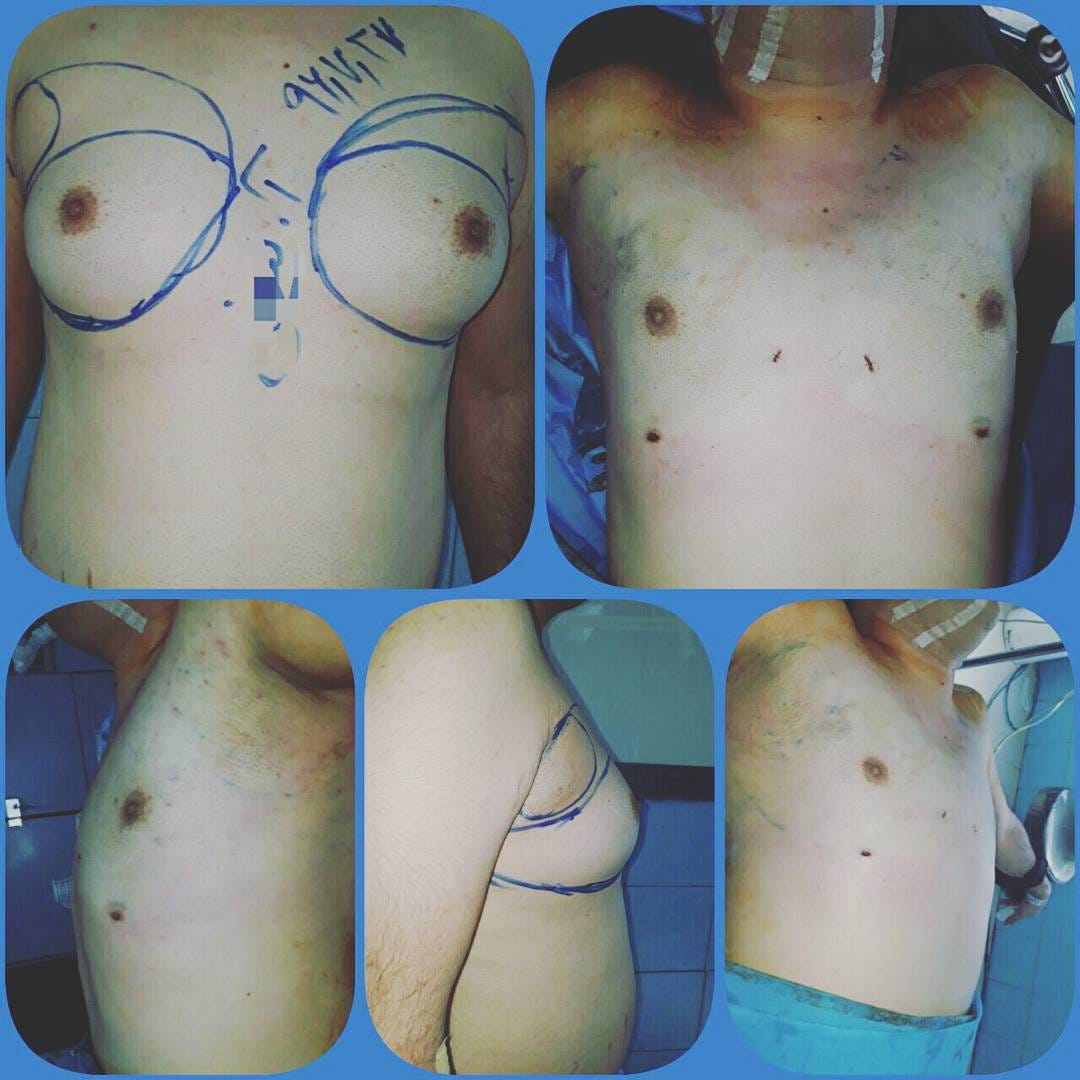 liposuction for breast reduction Ucf guys nude