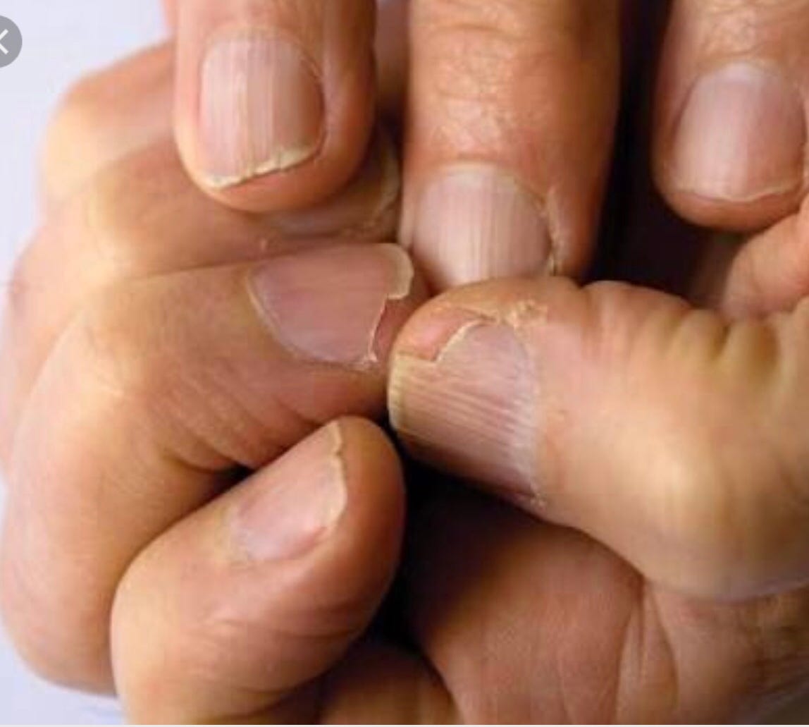 Onychorrhexis Brittle Nails Today Science Medium Everyone Strives To Have Beautiful Nails But Brittle Can Spoil The Beauty Weak And That Easily Become Ed Or Chipped Are A