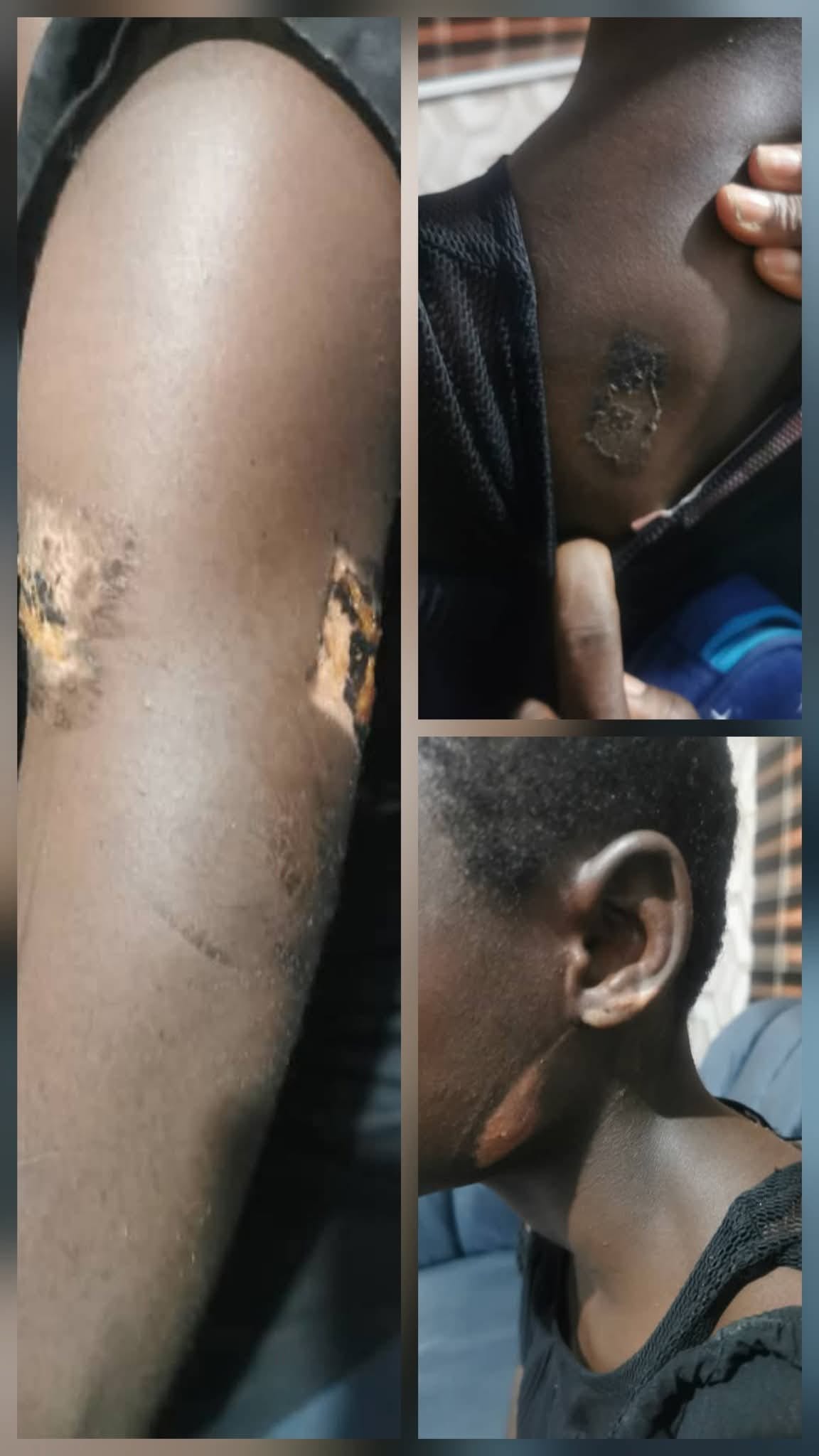 GUARDIAN ARRESTED FOR ALLEGEDLY BURNING TEEN WITH HOT KNIFE IN PORT HARCOURT — FIDA RESCUES VICTIM