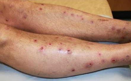 Cara Alami Menyembuhkan Penyakit Herpes Di Kaki Mengatasi Penyakit