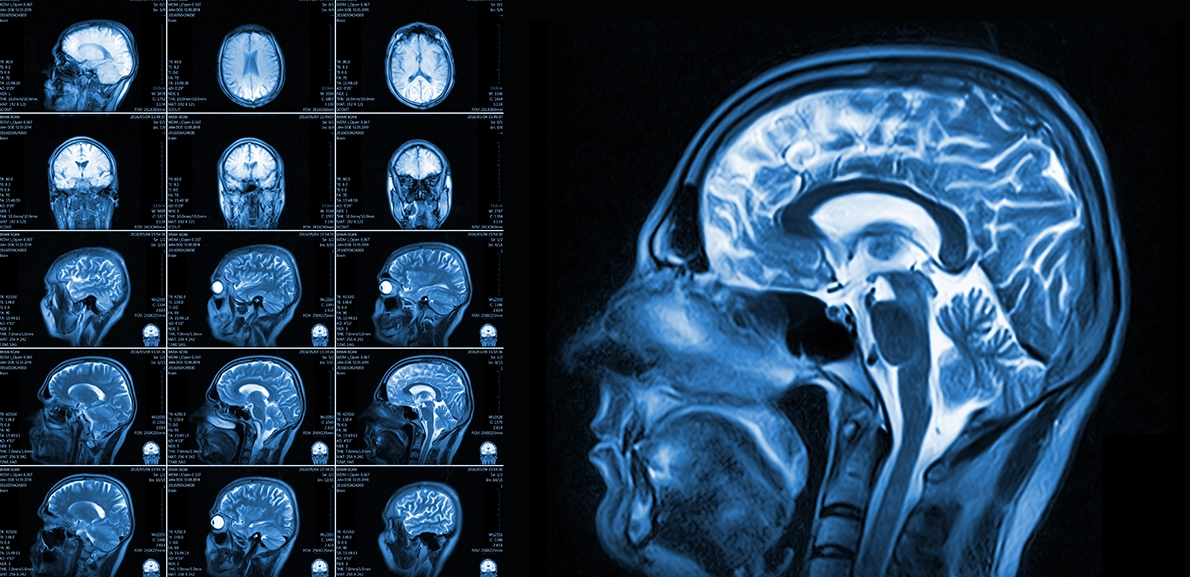From CNN to YOLO: Building a Brain Tumor Detection System Using Deep Learning