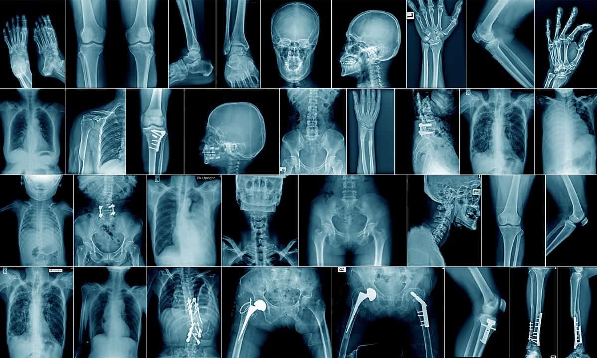 The Rise and Fall of AI in Radiology: A Real-Life Case Study