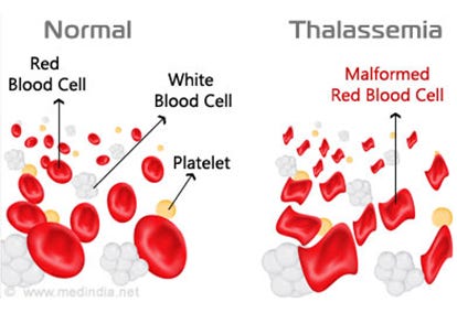 Thalassemia – Mirage Search – Medium