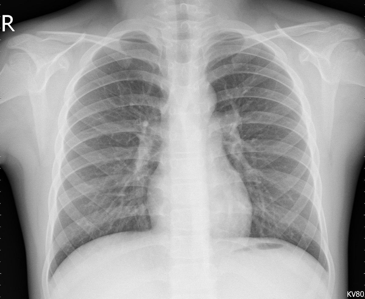 Detecting pneumonia on X-ray images — CovNets and Transfer Learning