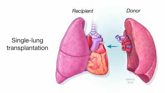 Lung Transplant in India Paving Way for Revolutionising 