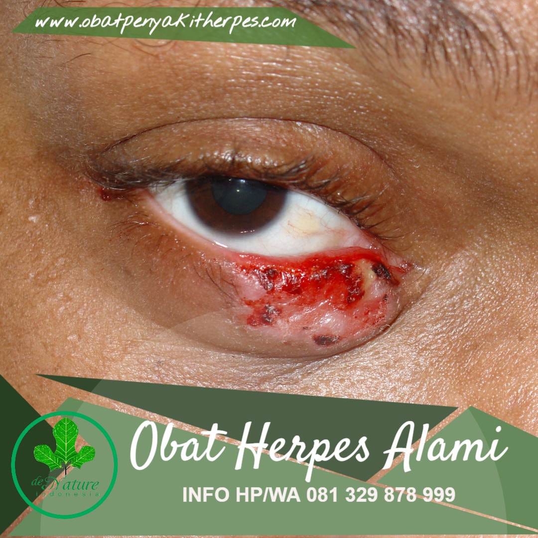 penyebab herpes di kaki