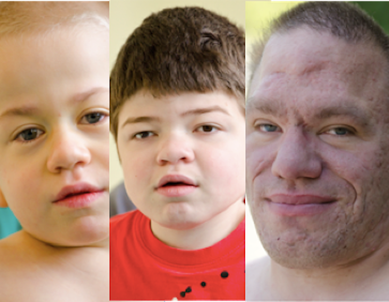 hunter syndrome el boys sindrome disorder mortality faces genetic recognize affects million alteraciones metabolismo asociadas carbohidratos los