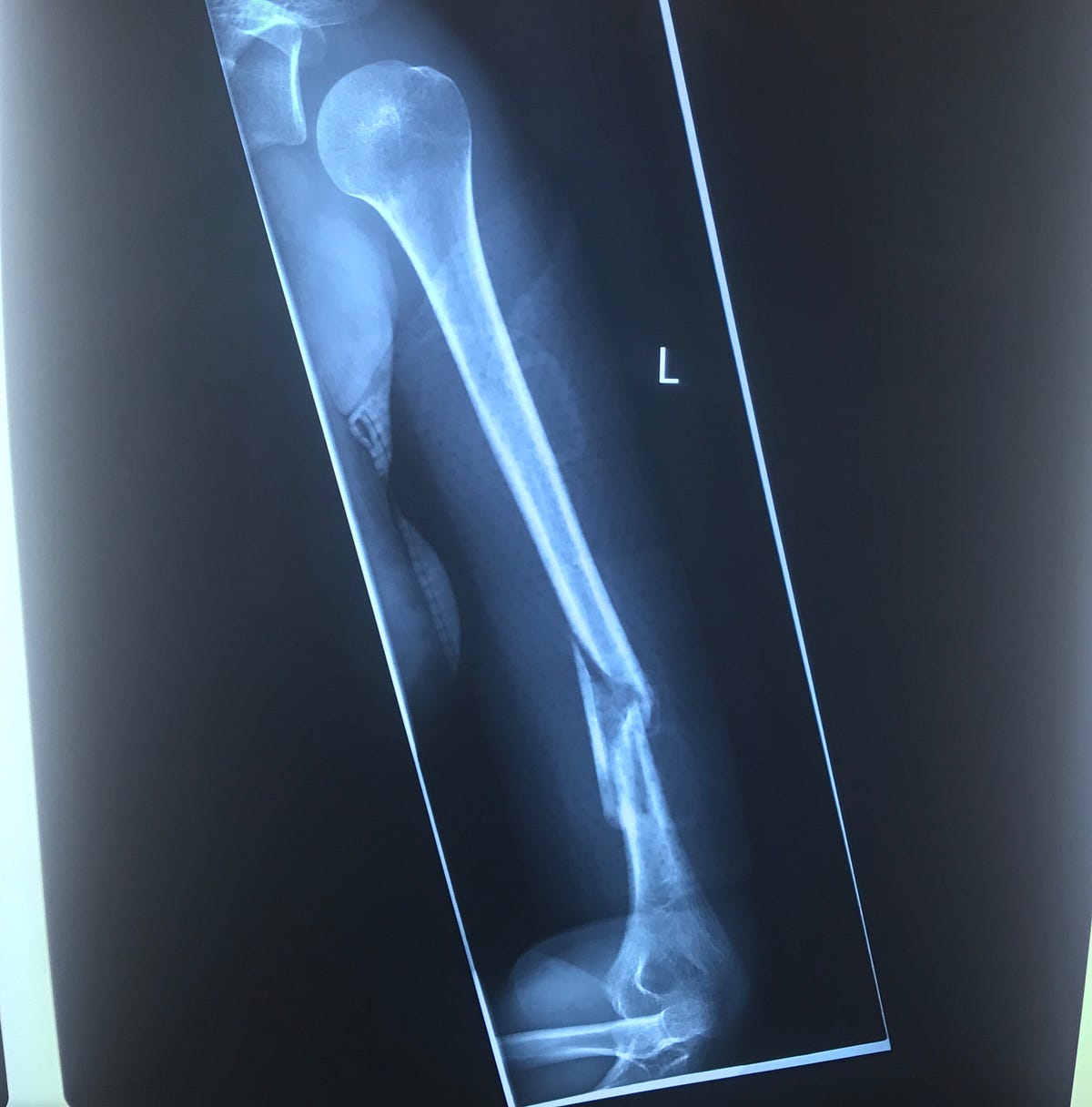 A Broken Humerus — Road to Recovery Maddie Wirthman Medium