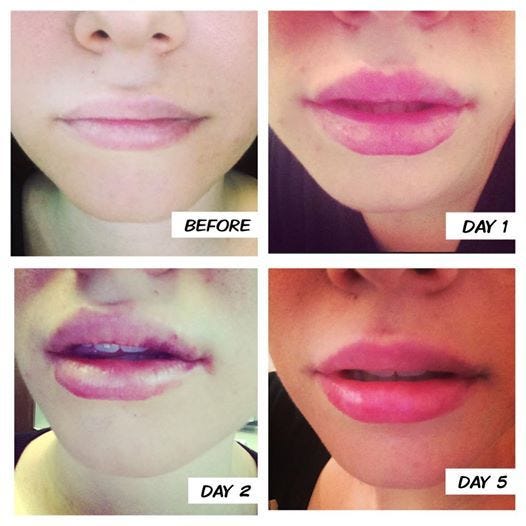 Lip Injections The Trend haley milligan Medium